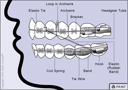 Parts of Your Braces